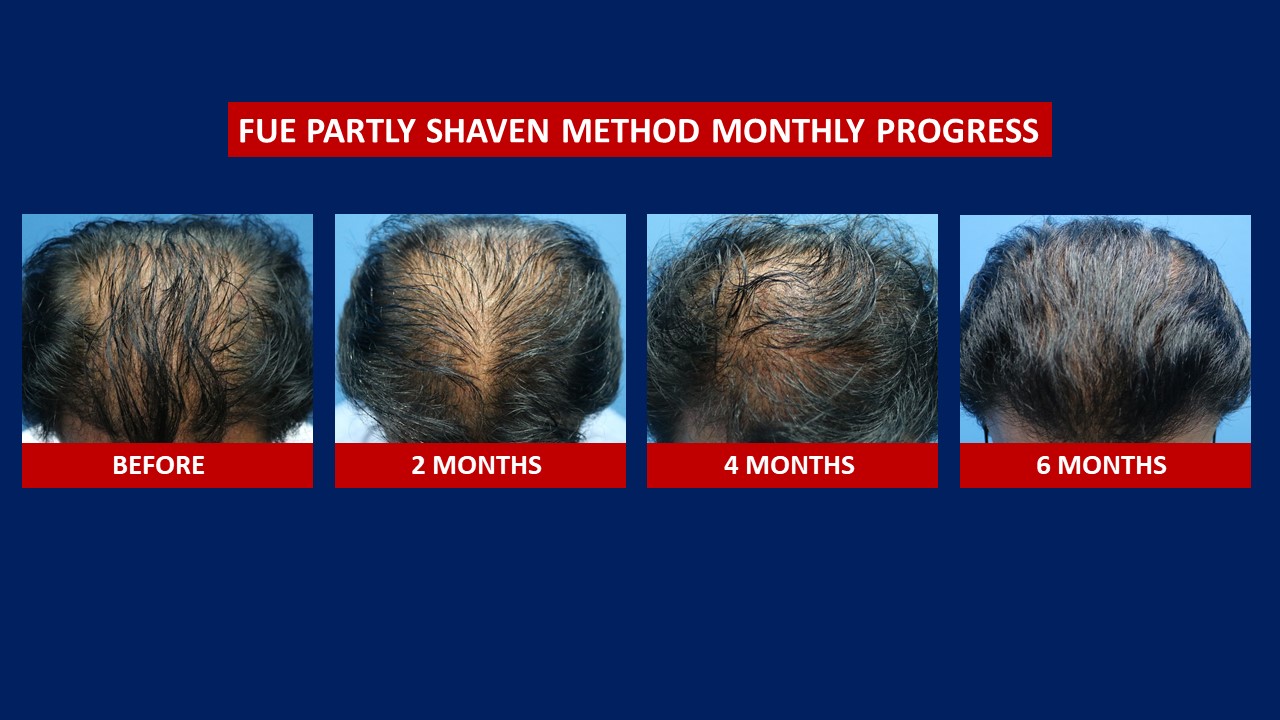 FUE Hair Transplant Before After Hair Transplant Centre FUE Hair Transplant Before After Hair Transplant Centre