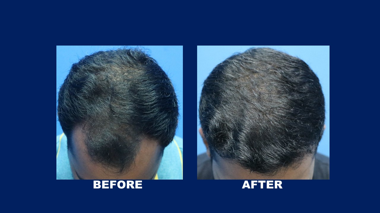 How Much Is A Hair Transplant In The Philippines
