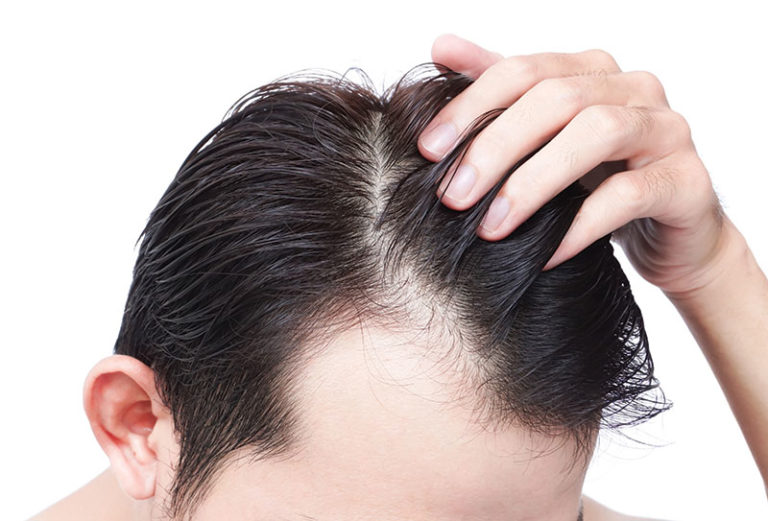 Man Having Hair Loss