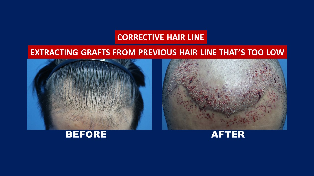 How Much Is A Hair Transplant In The Philippines