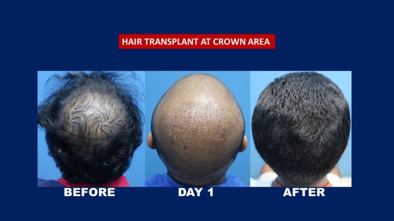result for crown hair transplant