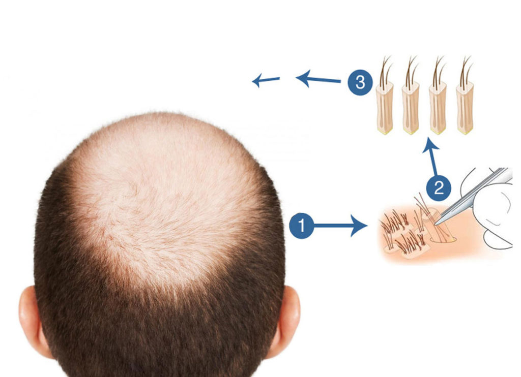 FUE Process Treatment